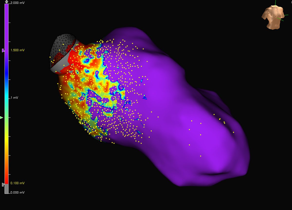 DrRoderickTung's tweet image. Beautiful periaortic VT with inferior breakout. Correlations with voltage, ILAM, and EGMs. #ablateVT