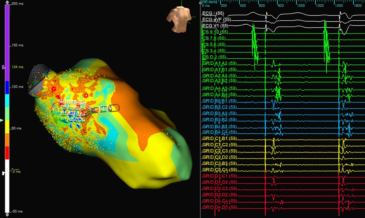 DrRoderickTung's tweet image. Beautiful periaortic VT with inferior breakout. Correlations with voltage, ILAM, and EGMs. #ablateVT