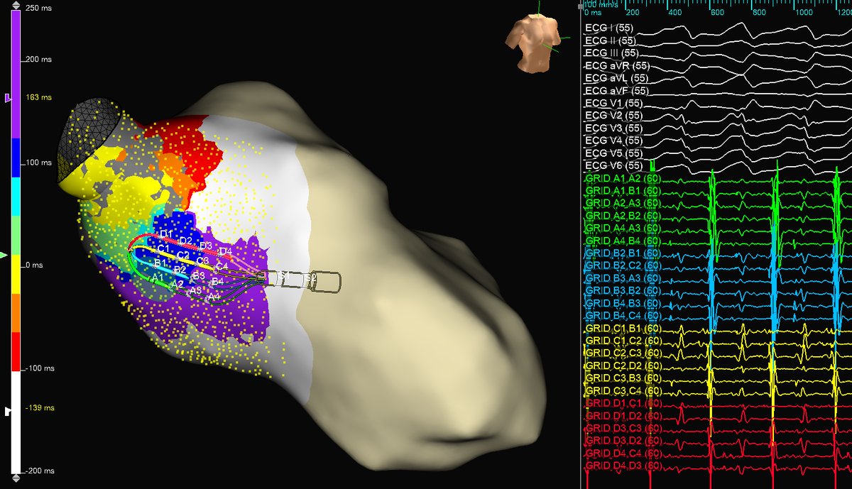 DrRoderickTung's tweet image. Beautiful periaortic VT with inferior breakout. Correlations with voltage, ILAM, and EGMs. #ablateVT