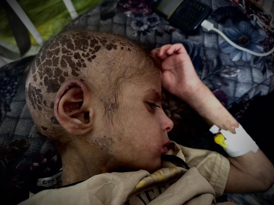 Timesofgaza's tweet image. Gaza children are suffering with no treatment.