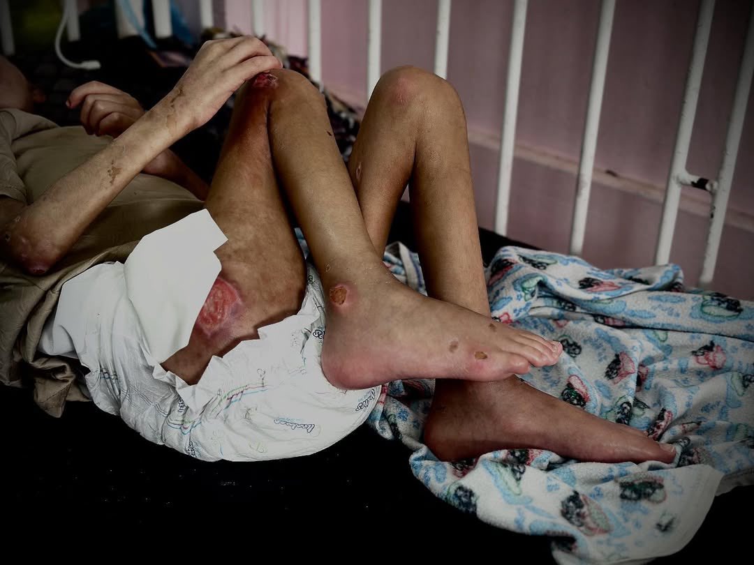 Timesofgaza's tweet image. Gaza children are suffering with no treatment.