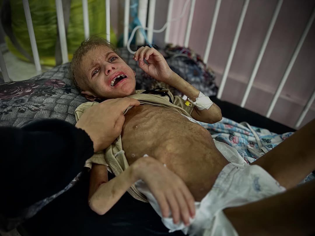 Timesofgaza's tweet image. Gaza children are suffering with no treatment.