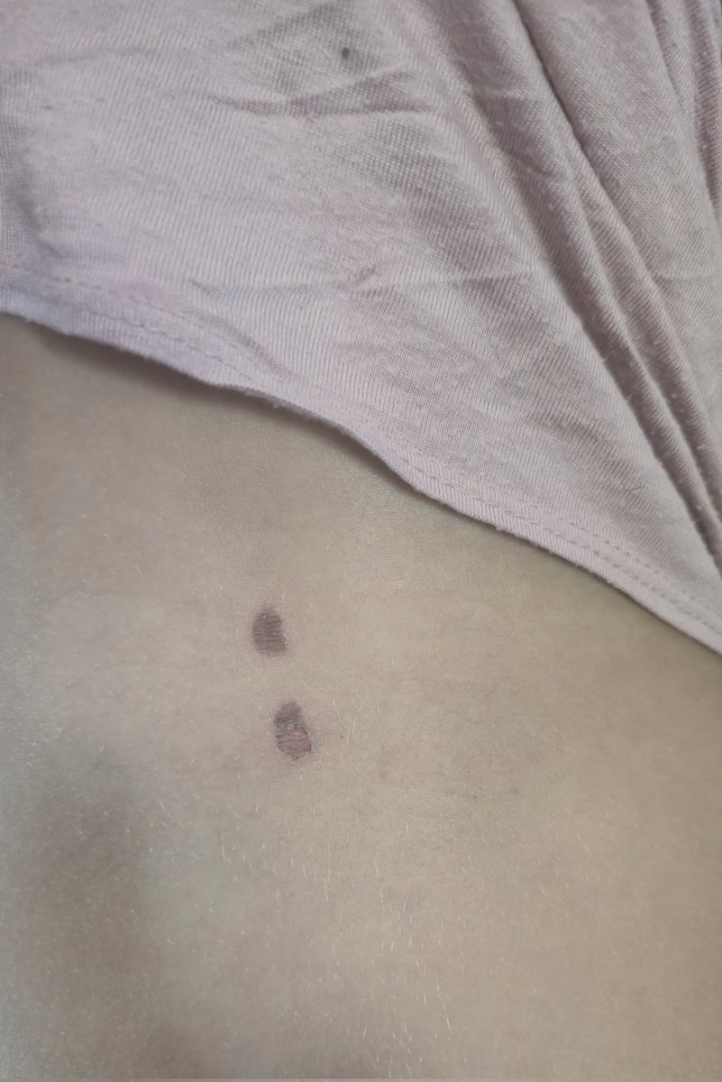 MrMurphy4th's tweet photo. @UptownJungleFun #laveen 6310 S 35th Ave, Phoenix, AZ 85041 #unsafe @abc15 This was my daughters back after a day at this uptown jungle. The next picture is this am. Hopefully, we dont end up in PCH..... #DoBetter https://t.co/szdybtOkAn