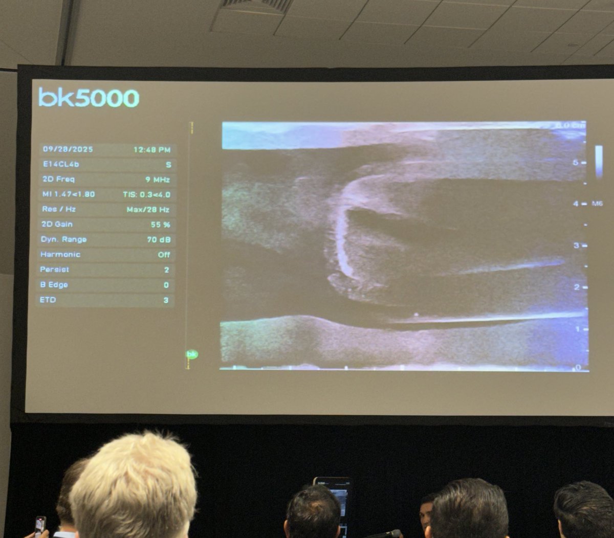 mustafabasree's tweet image. Interesting talk at #ASTRO25 by 4 #RadOncs reviewing safety &amp;amp; dosimetric data, and demonstrating placement of the @BioprotectS balloon implant. 

Good times in the perirectal spacing world for prostate.