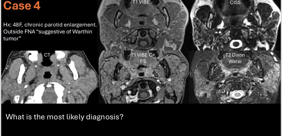 HeadNeckRads's tweet photo. Chronic parotid enlargement, FNA reportedly suggestive of Warthin tumor
Can you guess the real diagnosis?
@francisdeng at #ASHNR25 https://t.co/tNTjMhlz71
