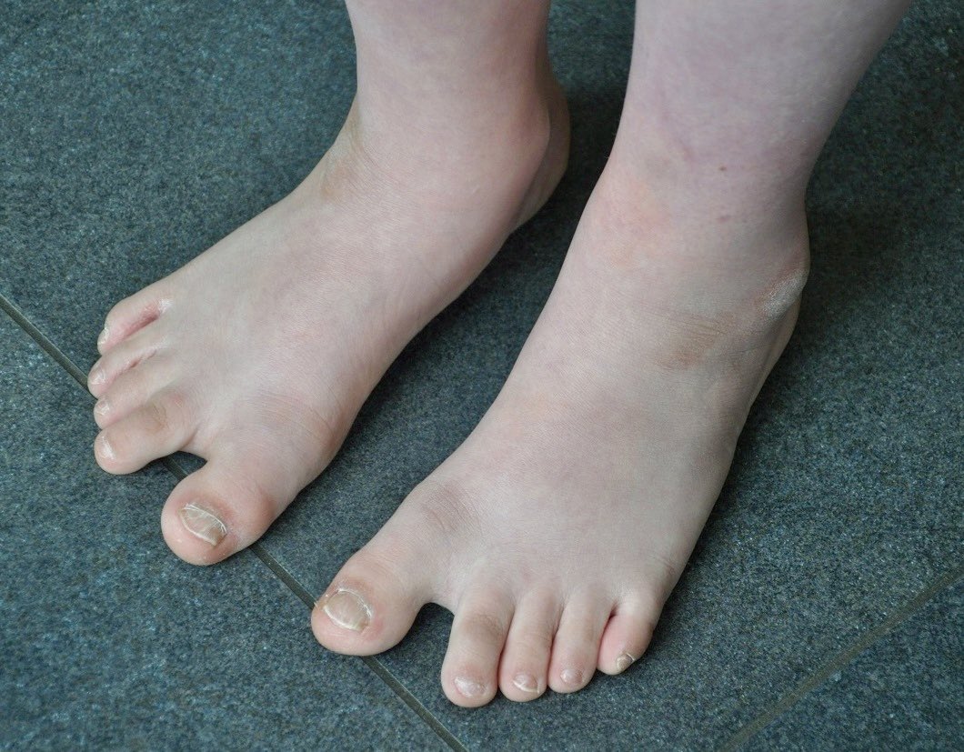 This 8-year-old has intellectual disability and a congenital heart defect

What is this finding?

Diagnosis?