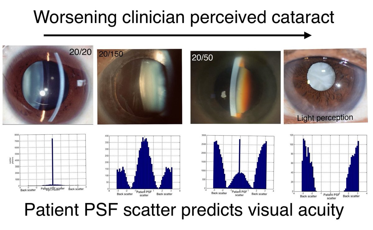 Intuortec's tweet image. Understanding why the cataract often doesn't match the reduced vision