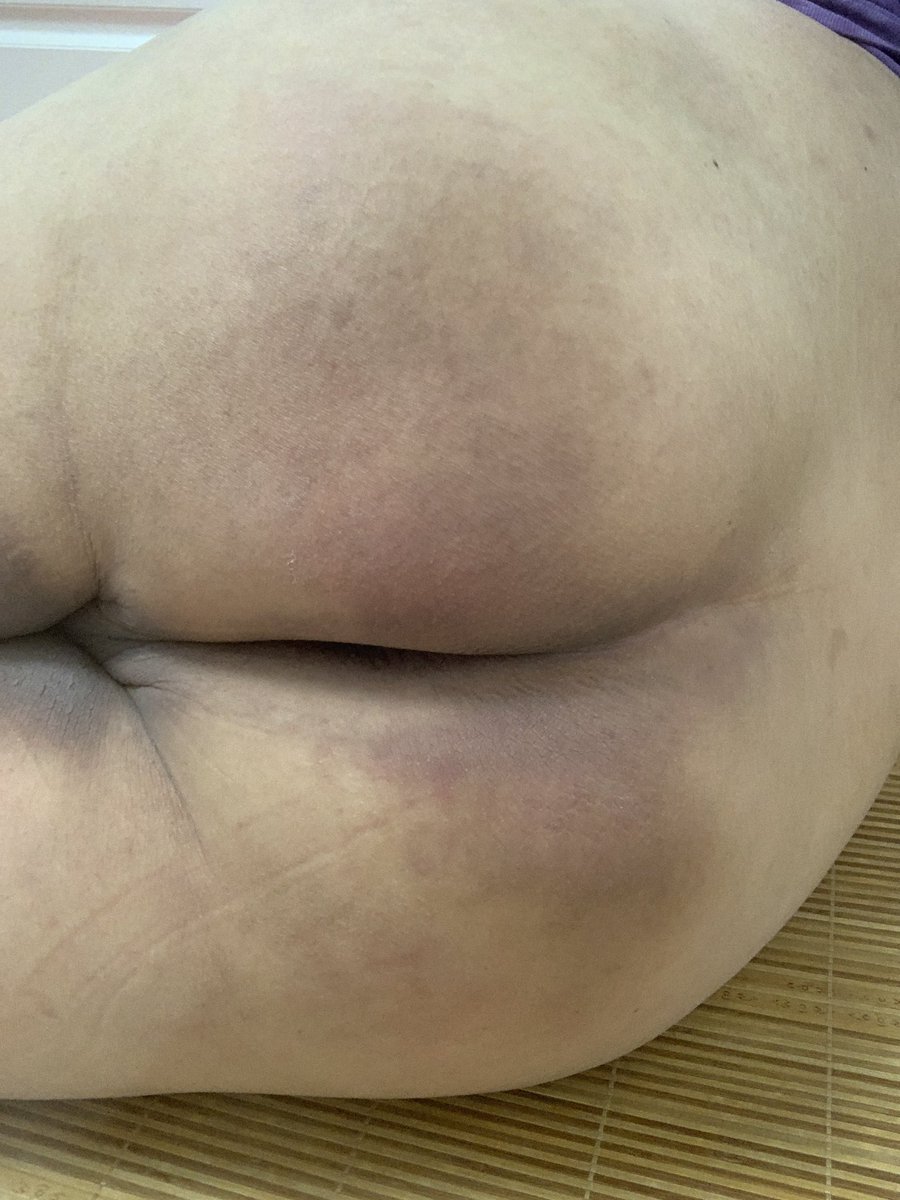 屁股几乎好了啊！那么有想网调的爸爸妈妈吗？