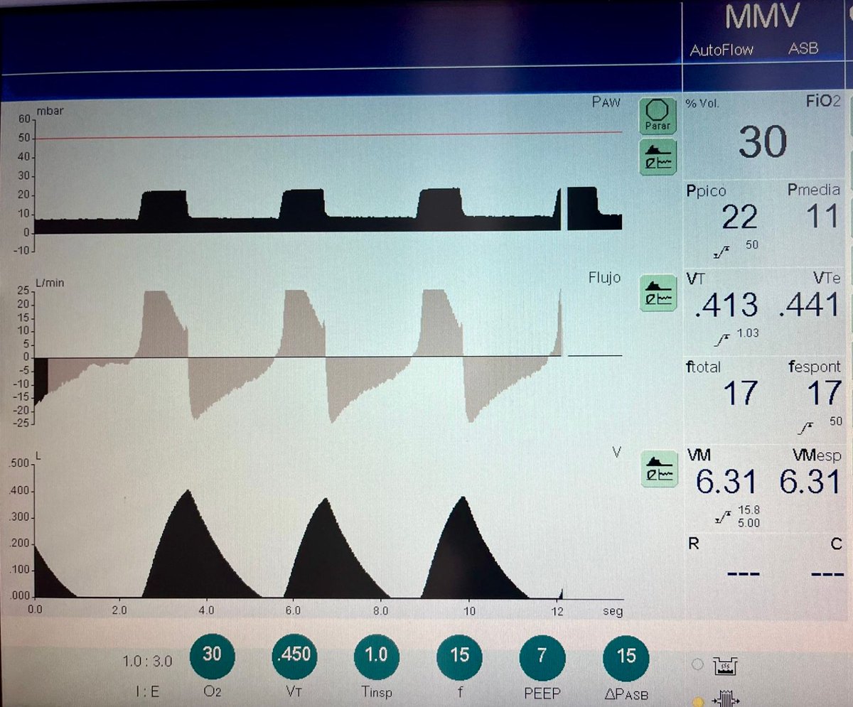 Do you know about MMV and AMV ? 

Less usual ventilatory modes: Mandatory Minute Ventilation and Adaptive Minute Ventilation 

journalmechanicalventilation.com/2025-september…