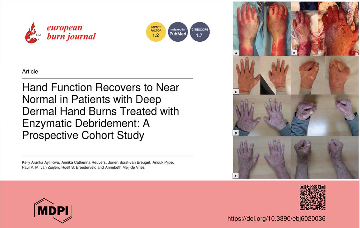📢 New in #EBJ: Enzymatic debridement supports hand recovery after deep dermal burns ✋🔥
✅ Near-normal ROM at 12 months
✅ Improved scar quality &amp; QoL
✅ &gt;50% hands normal on function tests
✅ All employed pts back to work
🔗 mdpi.com/2673-1991/6/2/…
#BurnCare #Rehab