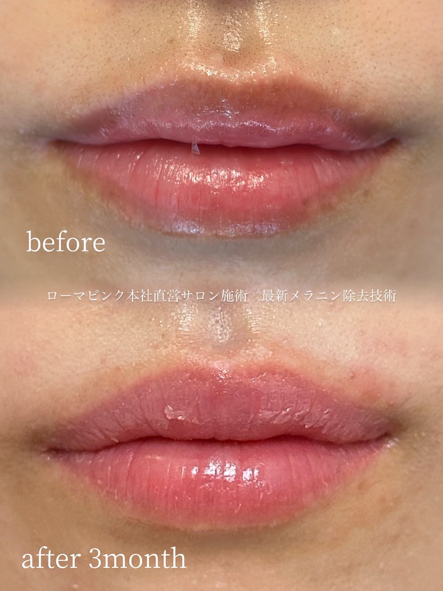 ローマピンク　シルバー1本 新品】Roma pink ボディアフタークリーム ローマピンク シルバー1本