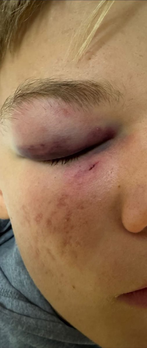 Ein Bericht aus Fürstenwalde im Brandenburger Landkreis Oder-Spree: 

„Heute ist etwas passiert, das kein Vater erleben sollte: Mein Sohn, 15 Jahre alt, wurde am helllichten Tag auf dem Heimweg von der Schule von mehreren Jugendlichen brutal angegriffen. Das Ergebnis: eine