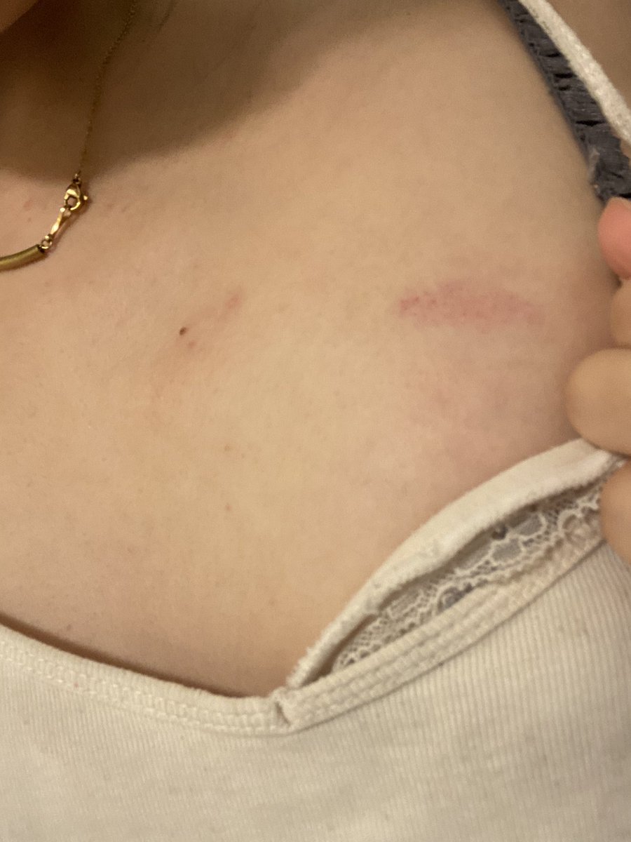 tyubuyametai's tweet image. pさんに「俺との事後ツイートしてよ〜😁」と言われたのでします！笑　嫉妬した人は私を虐めに来て下さい_(:3 」∠)_　これは会社の人にバレないように付けられたキスマとただの虫刺され🐛
#p活　#p活福岡　#天神