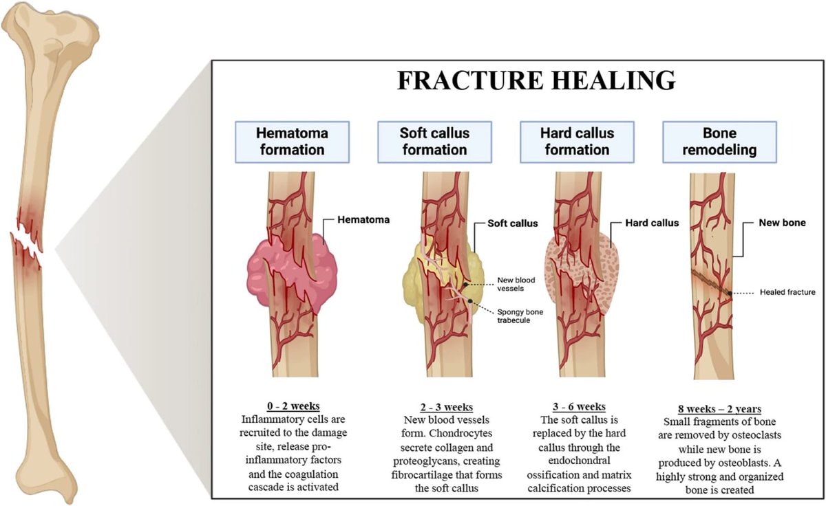 Stages of Bone Fracture Healing

<a href="/TDekkersPhysio/">Thomas Dekkers | Spinal Specialist Physiotherapist</a> <a href="/Retlouping/">ɹǝʇlnoԀ pıʌɐᗡ 🚴🏻 🇺🇸 🇦🇺 🇬🇧</a> 

cellregeneration.springeropen.com/articles/10.11…