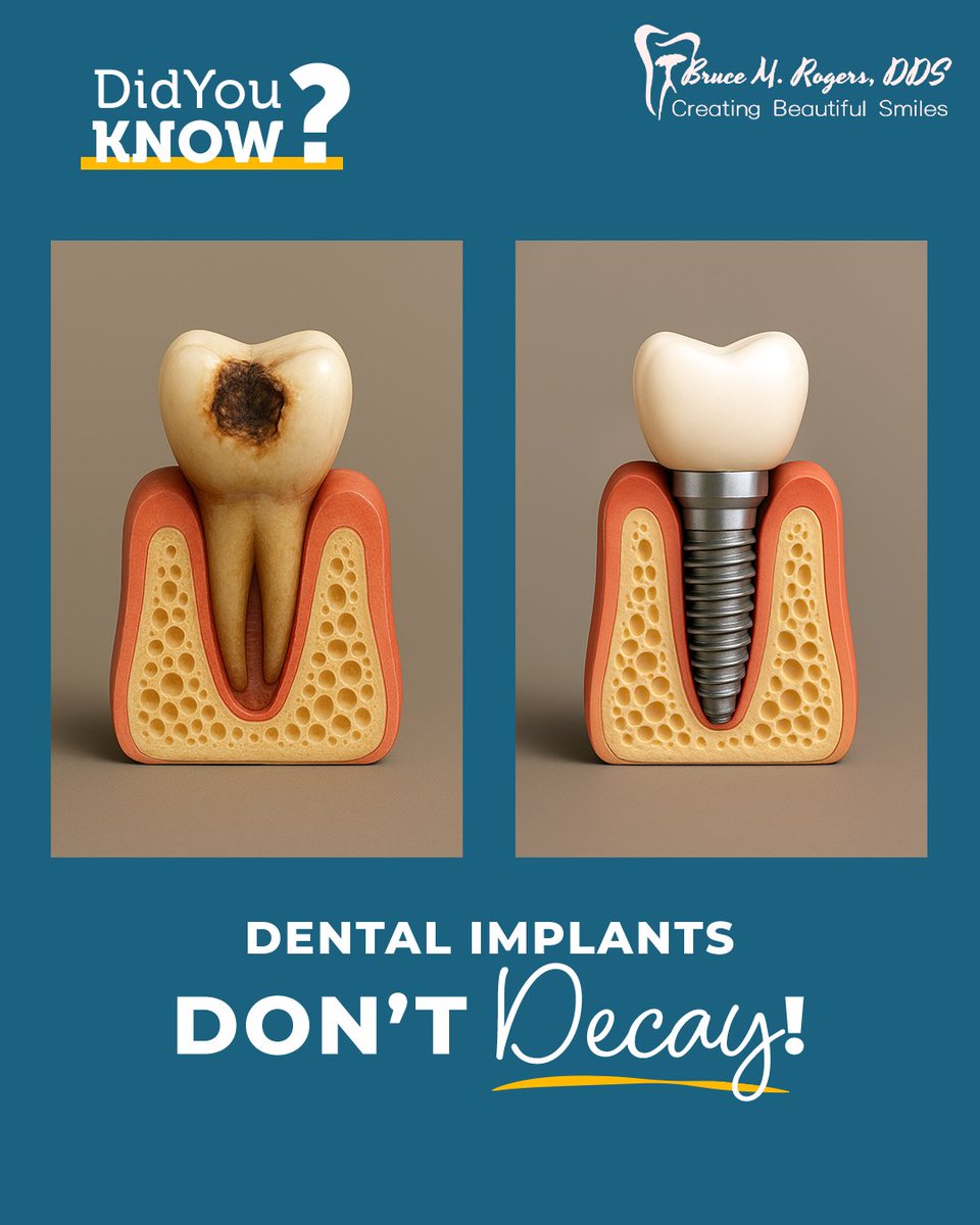 brucerogersdds's tweet image. 🌟 Did You Know?  🤔💡

Dental Implants Don’t Decay! 😲

Unlike natural #teeth 🦷, #DentalImplants are cavity-proof🦠, durable, and can last a lifetime ⏳. They restore #functionality 🍎 and #beauty ✨ so you can eat, speak, and #smile with #confidence 😁.

#HealthySmile