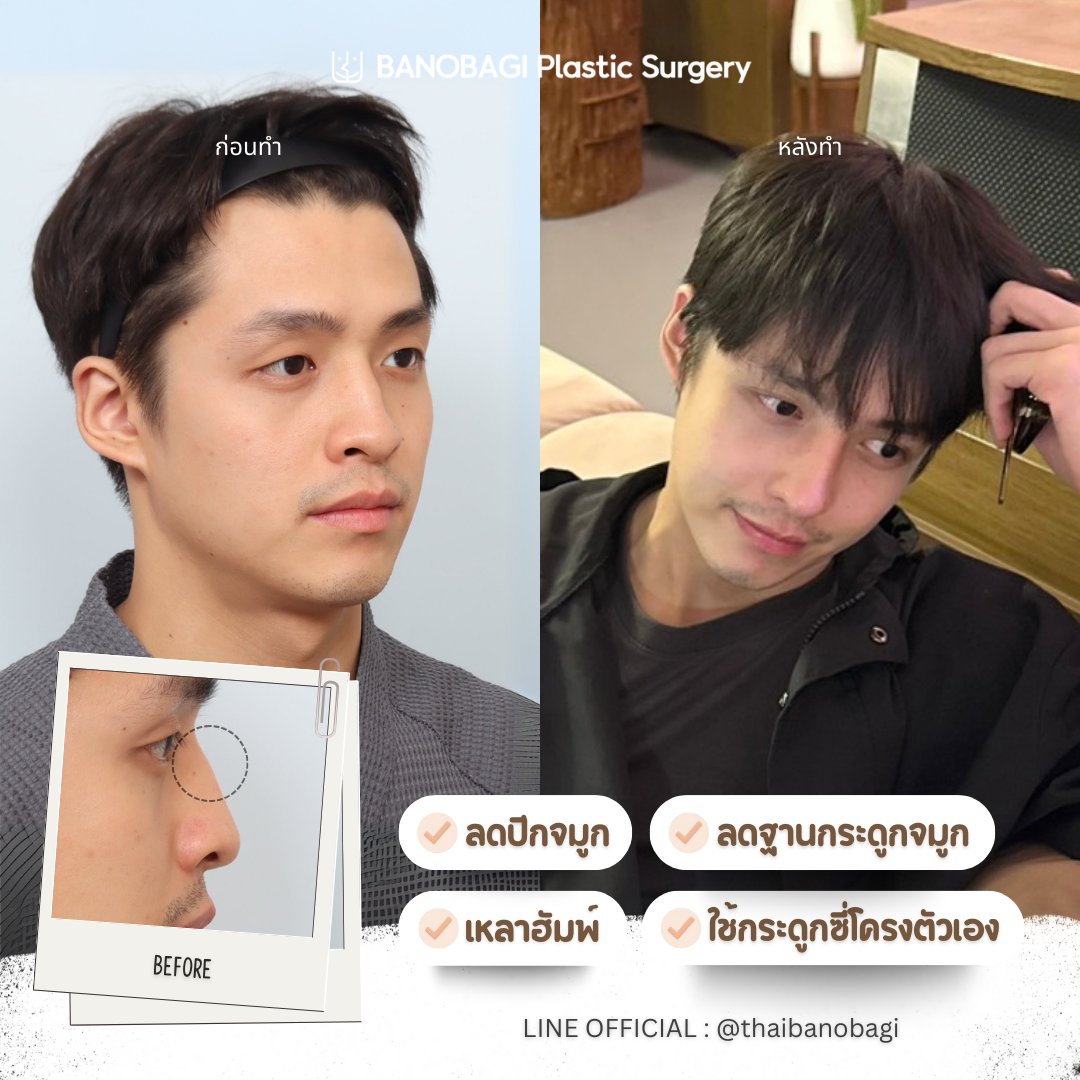 banobagithai's tweet image. เปลี่ยนลุค!
จากหนุ่มตี๋ตาขีด &amp;gt;&amp;gt; เป็นหนุ่มตี๋อินเตอร์ 🤩✨

รีวิวจริง จากคุณเฮง หนุ่มตี๋ของบาโนบากิ
ทำรายการอะไรไปบ้าง มาดู 👀

#banobagi #บาโนบากิ  #โครงหน้า #ตาสองชั้น #เสริมจมูก  #งานปรึกษาศัลยกรรม #ศัลยกรรมเกาหลี #โปรโมชั่น