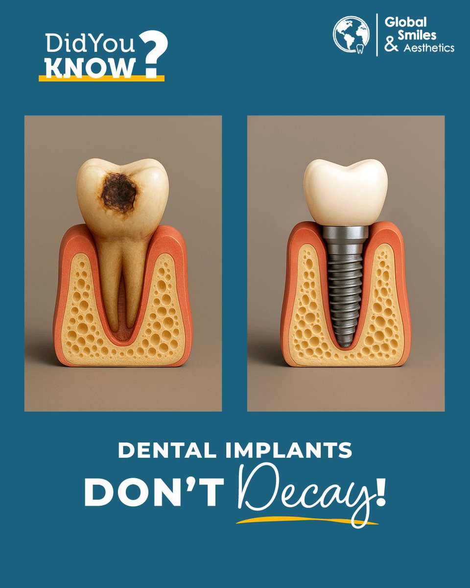 global__smiles's tweet image. 🌟 Did You Know?  🤔💡

Dental Implants Don’t Decay! 😲

Unlike natural #teeth 🦷, #DentalImplants are cavity-proof🦠, durable, and can last a lifetime ⏳. They restore #functionality 🍎 and #beauty ✨ so you can eat, speak, and #smile with #confidence 😁.

#HealthySmile