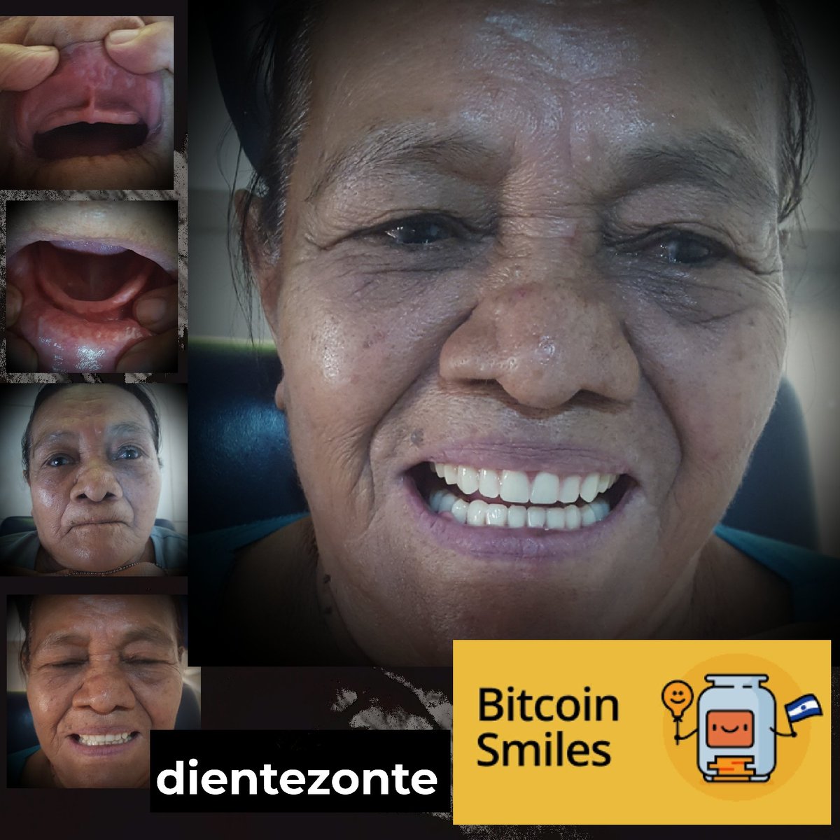 She had 6 children and currently lives with 1 of them. She uses her low income to buy food which can't chew properly, causing digestive problems. Thanks to 💛 BitcoinSmiles, we have honored Cornelia restoring her confidence and smile + improving her masticatory function🏆⚡🇸🇻