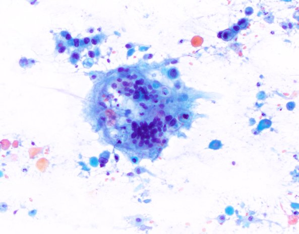 VandaTorousMD's tweet image. Multinucleated giant cell chomping keratin debris in this squamous cell carcinoma
#CytoPath #PathTwitter