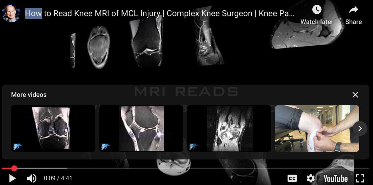 thekneedoc's tweet image. How do you read an MRI of an #MCLinjury? Dr. LaPrade walks through a real case involving a skiing accident.
➡️ See the injury
➡️ Learn what to look for
Full breakdown ➡️ medilink.us/svru #Orthopedics #KneeMRI #MCLtear