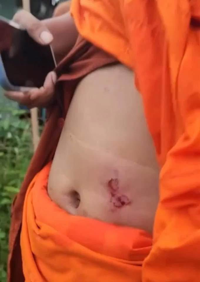 Ravuth_Rith's tweet photo. Cambodian Soldiers and Civilians Injured by Thai Military Slingshots, including monks, injured after the Thai military allegedly used slingshots and tear gas in Prey Chan village, O’Beichoan commune, Ou Chrov district, Banteay Meanchey province.

H.E Neth Pheaktra posted on FB. https://t.co/EYRmAnbnmI