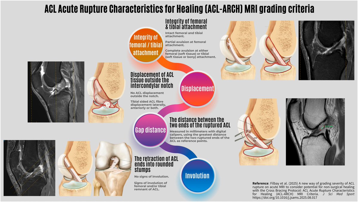 A New Way of Grading Severity of ACL Rupture

"In this paper we introduce a new way of grading acute ACL rupture on MRI to assess features that are relevant to ACL healing potential"

<a href="/stephfilbay/">A/Prof Stephanie Filbay</a> <a href="/DerekGriffin86/">Derek Griffin</a> <a href="/Retlouping/">ɹǝʇlnoԀ pıʌɐᗡ 🚴🏻 🇺🇸 🇦🇺 🇬🇧</a> <a href="/tomgoom/">Running-Physio</a> <a href="/PhysioMeScience/">Physio Meets Science</a> <a href="/AdamMeakins/">The Sp⚽️rts Physio</a> <a href="/TDekkersPhysio/">Thomas Dekkers | Spinal Specialist Physiotherapist</a>