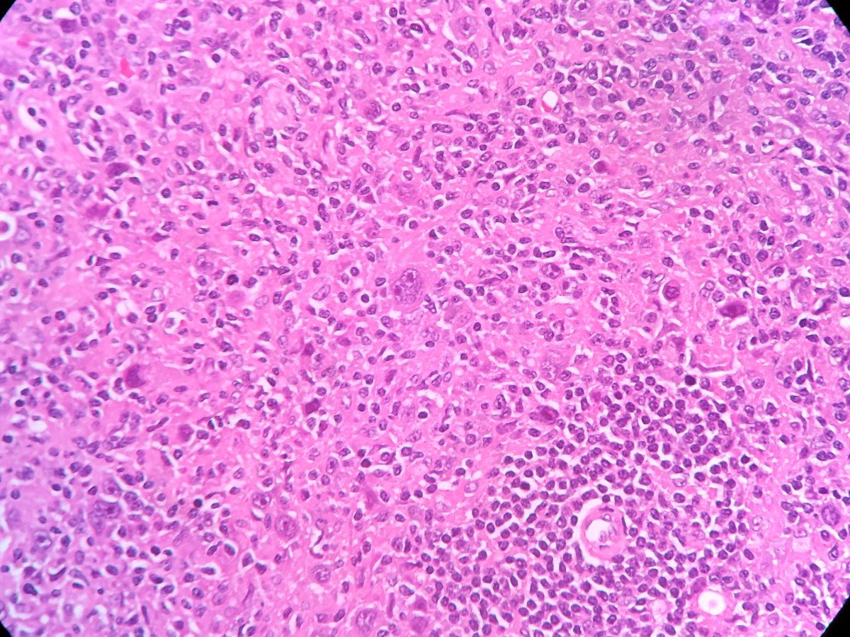 #PathClassics #FNAC
Classic Reed Sternberg cell (RS cell)
Owl-eye appearance
-binucleated with prominent eosinophilic nuclei surrounded by abundant cytoplasm
Mononuclear are known as Hodgkin cells
Mummified cells - dark-staining, condensed nucleus and dense eosinophilic cytoplasm