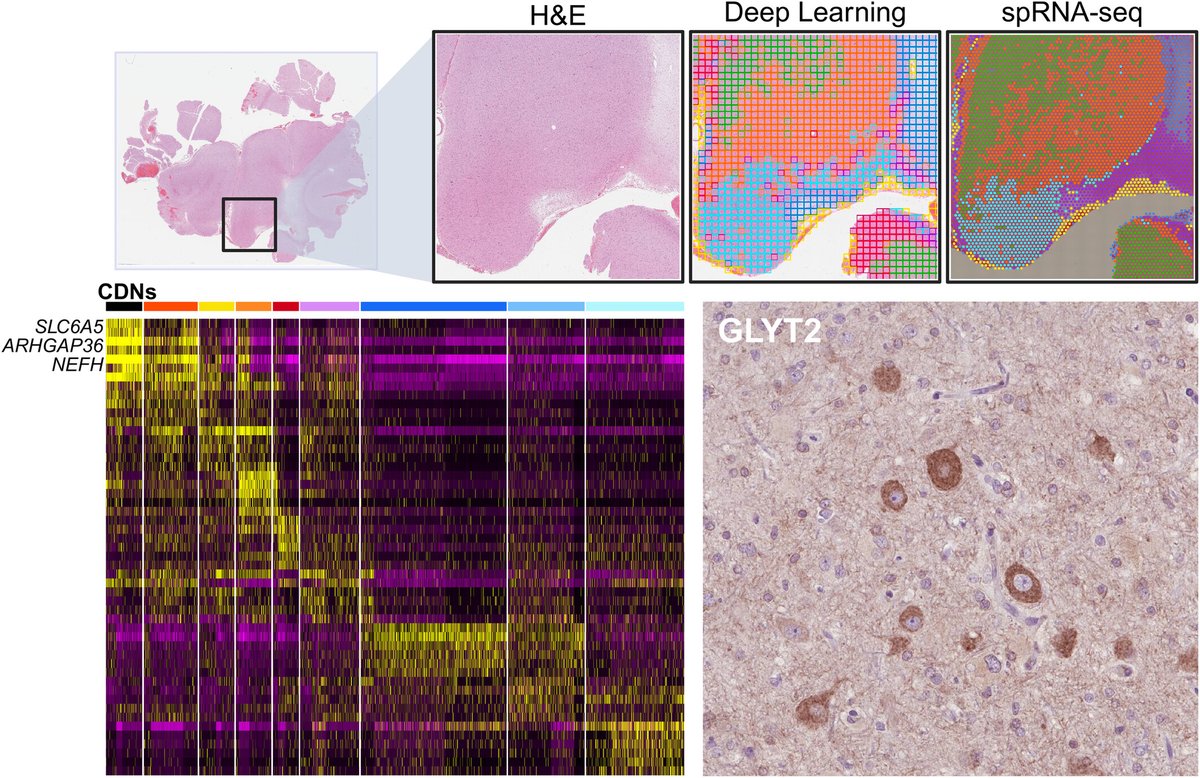 brainpathol's tweet image. Dysmorphic neurons express markers of inhibitory glycinergic signaling in focal cortical dysplasia IIb
onlinelibrary.wiley.com/doi/10.1111/bp…
@pdiamandisii