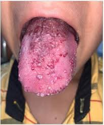 kenasaayele's tweet photo. Did you know swelling in the mouth or neck areas is found in your children?
* may it be vascular malformation types called lymphatic malformations.
The picture below shows a patient healed from it after sclerotherapy.
#dentist #tmj #oralhealth #vascularanomalies #drabreham https://t.co/U3NqhWUG0S