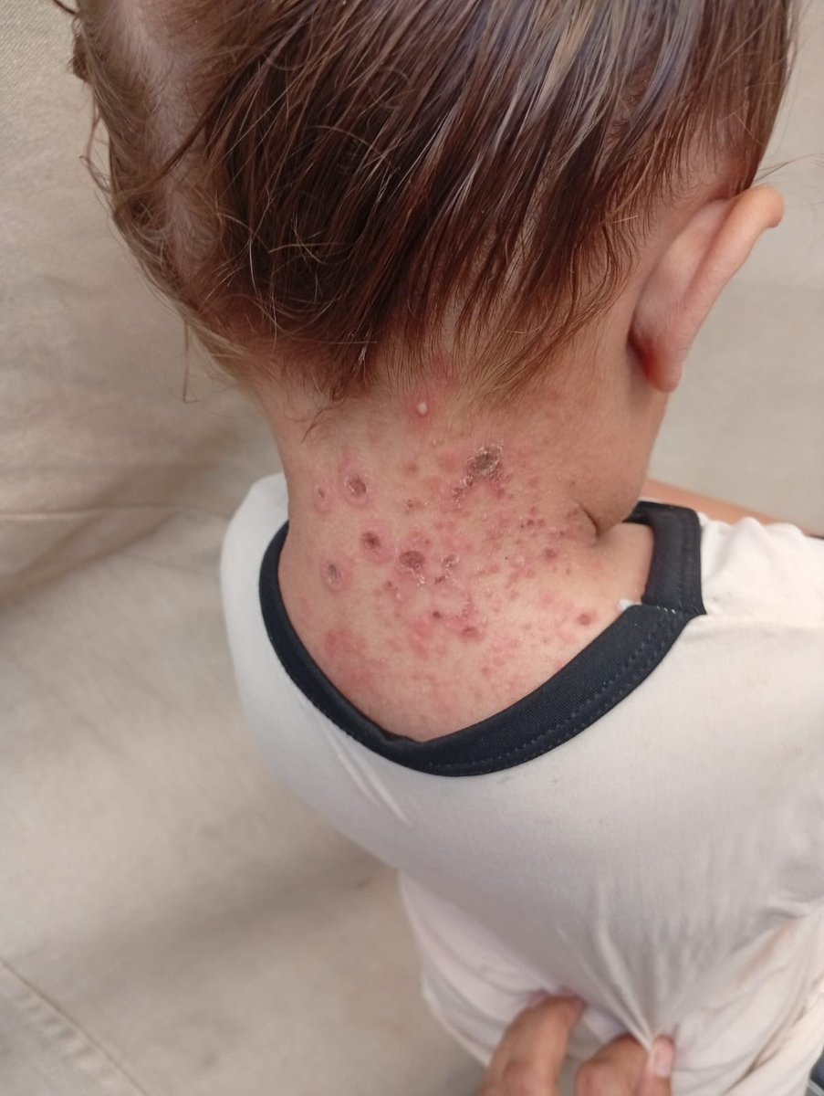 Kat_Zoe's tweet image. Baby Misk STILL needs your help

She has a full-body bleeding 🩸 rash
And it’s getting worse

She can’t afford the high prices of hygiene products, so her skin is always unclean

She needs:
- soap
- clean water
- clean clothes

G0al: $5 / $100‼️

chuffed.org/project/118420