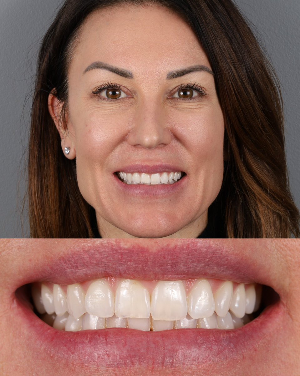 Swipe to see BEFORE ➡️
Patient’s goals: Her front tooth kept chipping and was getting shorter and shorter. She didn't like the symmetry of her smile and she wanted something natural, that really felt cohesive with herself.
What did we do? 10 porcelain Harmony veneers