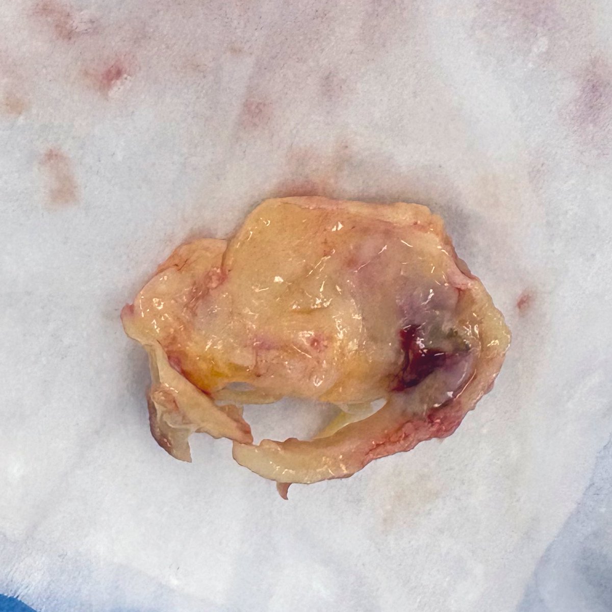 BabliakD's tweet image. Aortic + mitral valve replacement via right anterolateral thoracotomy (3rd ICS).
Severe MV stenosis + AR with deformed leaflets.
Minimally invasive. Reliable exposure. Great recovery.
#MICS #CardiacSurgery