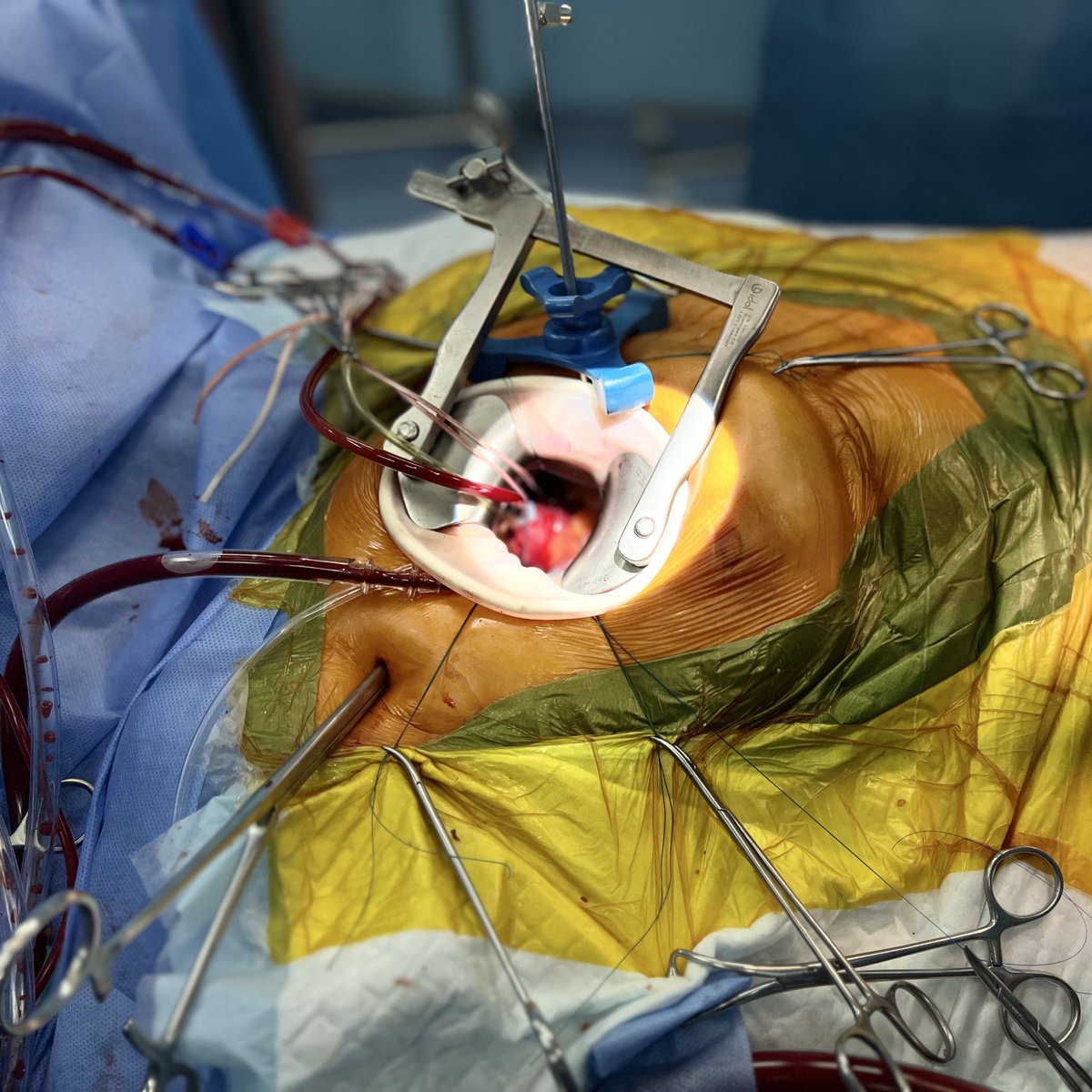 BabliakD's tweet image. Aortic + mitral valve replacement via right anterolateral thoracotomy (3rd ICS).
Severe MV stenosis + AR with deformed leaflets.
Minimally invasive. Reliable exposure. Great recovery.
#MICS #CardiacSurgery