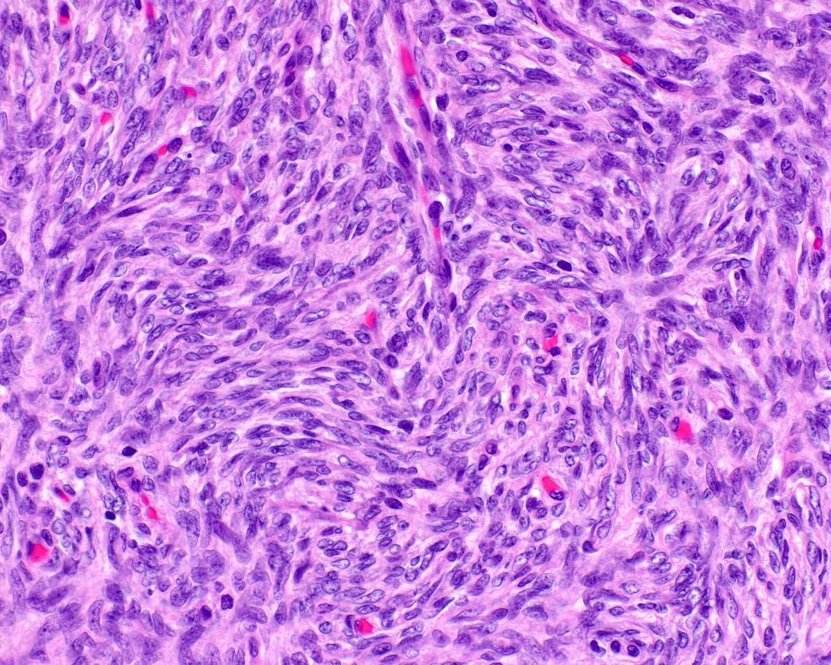 Dermatofibrosarcoma protuberans survival.  Molecular testing can be informative!
Yeung MCF, et al. Comprehensive Clinicopathological and Multiomics Characterization of Dermatofibrosarcoma Protuberans Revealed PDGFD Fusion as Distinct Molecular Subtype With Better Survival. Mod