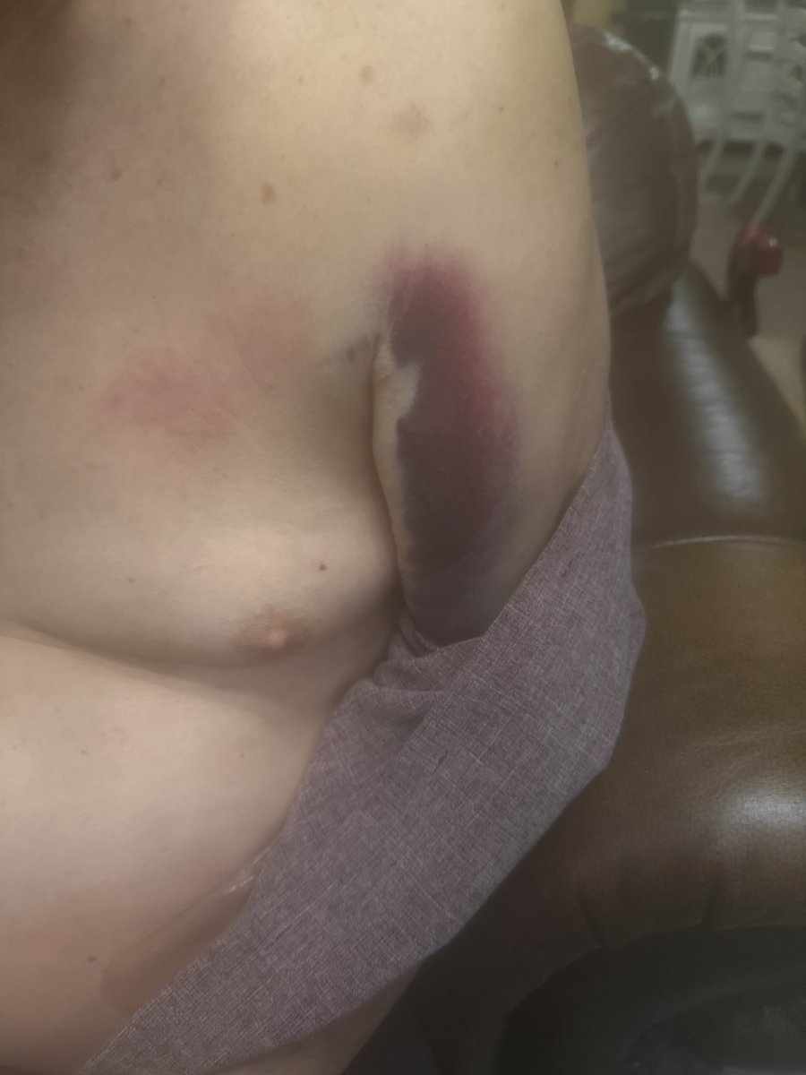 kdwarren1's tweet photo. I don’t know what happens to others, but this is what it looks like after I break a shoulder https://t.co/mpCdZWltvc