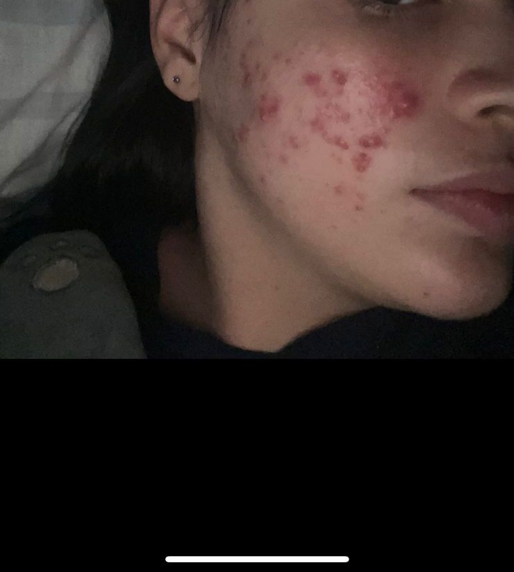 brinelacollado's tweet image. Clienta feliz de la línea #Teatree de @FarmasiRD resultados en pocas semanas 💜💖