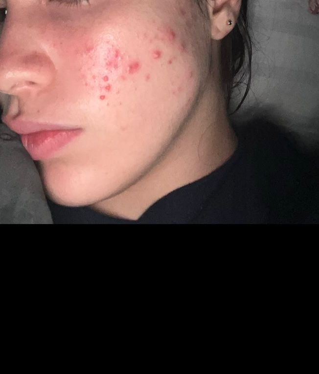 brinelacollado's tweet image. Clienta feliz de la línea #Teatree de @FarmasiRD resultados en pocas semanas 💜💖