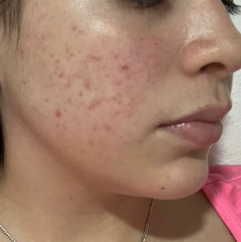 brinelacollado's tweet image. Clienta feliz de la línea #Teatree de @FarmasiRD resultados en pocas semanas 💜💖