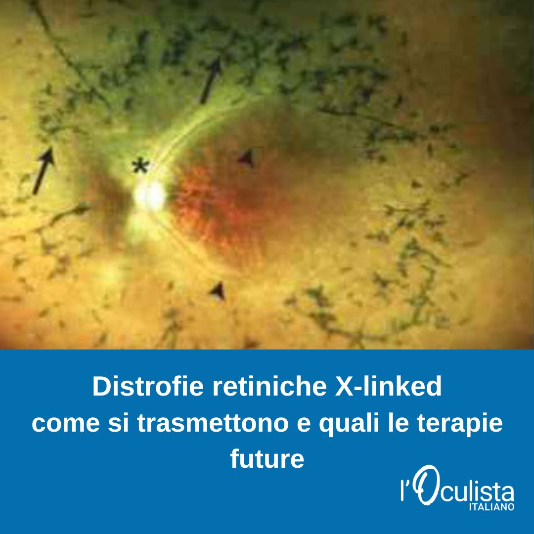 Distrofie retiniche legate al cromosoma X: cause genetiche, modalità di trasmissione e terapie in sviluppo
oculistaitaliano.it/articoli/distr…