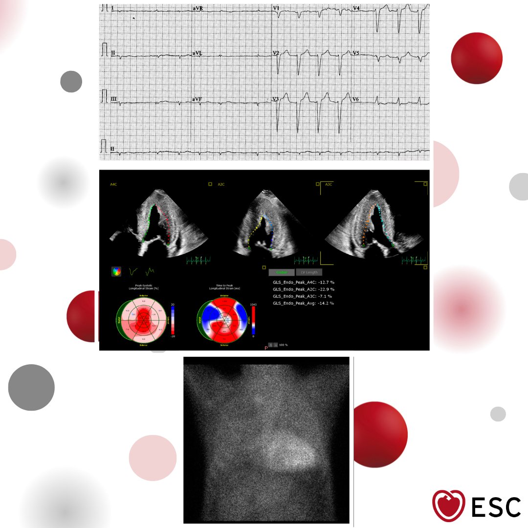 escardio's tweet image. #ImageOfTheWeek by Sung Chu Lung from the Cardiology Unit, Hospital Authority, Hong Kong, China.
A man in his 70s presents with heart failure. What is your diagnosis? ow.ly/cQ1s50WY14G

#cardioed