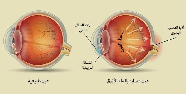 🔵 قد سمعنا اكيد بمصطلح الماء الأبيض ، والماء الأزرق واللي يصيبان العين ..

وعشان الناس تخلط بينهم كثير خاصة من المراجعين بالعيادة ، بوضحهم هنا : 

🔺الماء الأبيض ( الساد ) 
هو عتامة تصيب عدسة العين الداخلية واللي مسؤولة عن جزء كبير من الرؤية وشفافة بطبيعتها ( مو ظاهرة لك ) 
إما