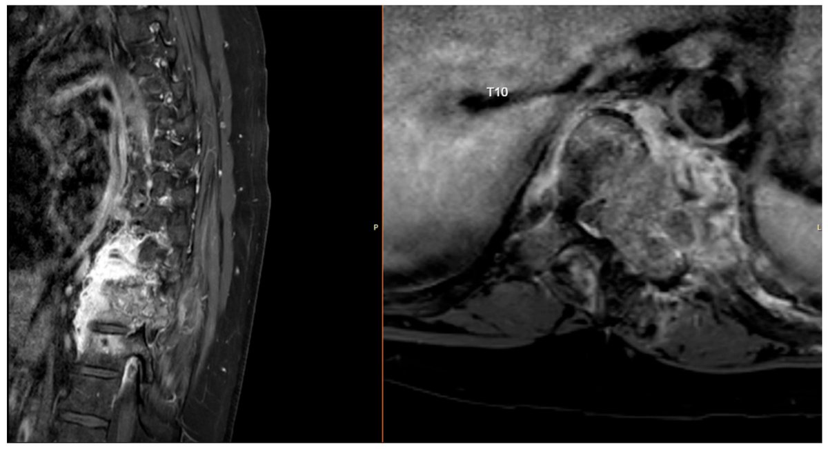 New publication in #Radiation!

💡Osteoblastoma of the Spine—A Clinical Challenge by Luca Cmelak et al.

🔗Read the full article here: mdpi.com/2673-592X/5/3/…

#Radiation #Osteoblastoma #SpinalTumors #SpineSurgery