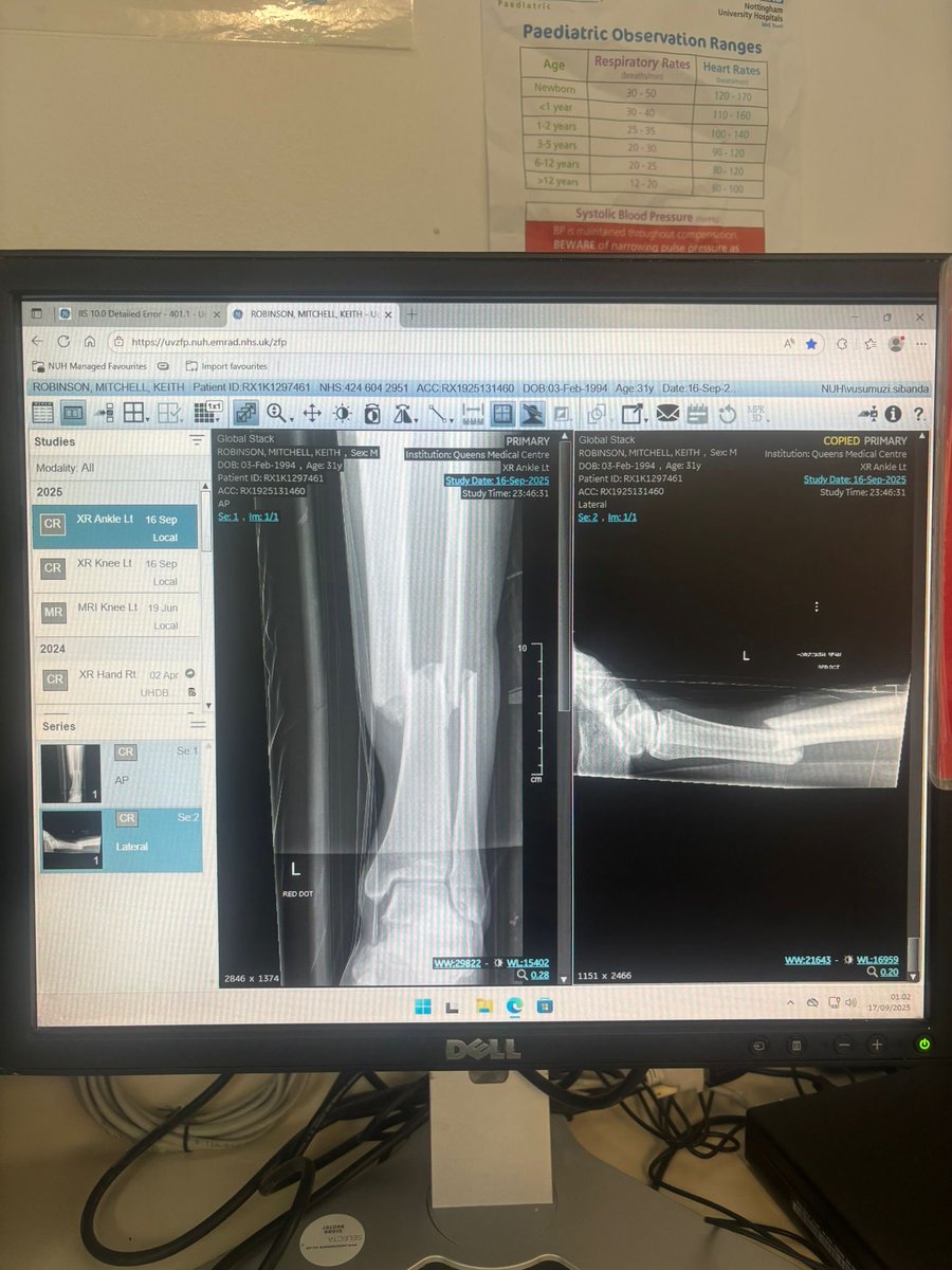 Just want to thank everyone who has reached out over the last couple of days. All your messages mean the world to me 💙 double break fibula and tibia, less than ideal but it is what it is. Had the operation yesterday and all went well so now just on the road to recovery 💪🏻💙