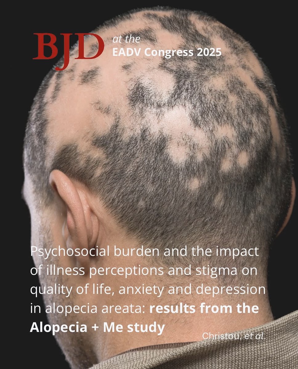 Day 2 at the EADV Congress. Today, we highlight a study looking beyond the physical symptoms of alopecia areata.

The Alopecia + Me study reveals alopecia areata's significant psychosocial burden and its impacts on patient quality of life.

Read more: doi.org/10.1093/bjd/lj…