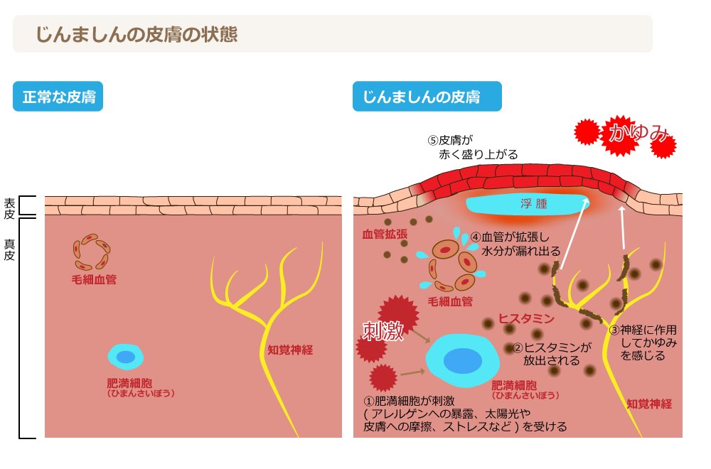 《最近多い蕁麻疹についての考察と思考》

蕁麻疹って、西洋医学だと「アレルギー」とか「ヒスタミン放出」とか言われますけど、東洋医学で見るともっと奥行きがあるんですよね。皮膚に出るのはあくまで氷山の一角で、内側の乱れ方によってタイプが違います。

まず多いのが「風邪＋血虚タイプ」。