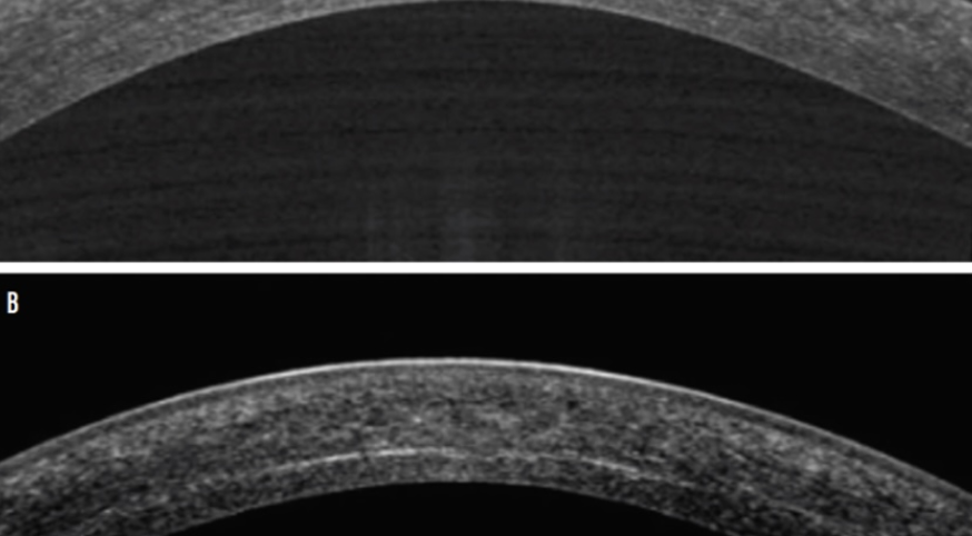 Postoperative outcomes and contact lens fitting with epi-on CXL
optometricmanagement.com/issues/2025/se…   #ContactLenses #CornealCrosslinking #ContactLensFitting