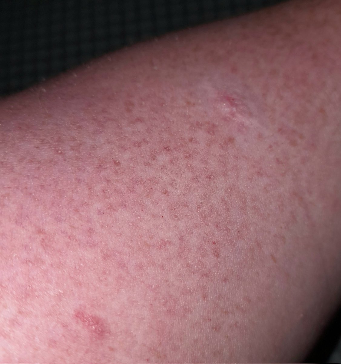howe_jacqueline's tweet image. These bumps are called #Keratosispilaris which is connected to another #SkinCondition called #Psoriasis perfectly harmless Psoriasis however is itchy stinging and burning at the same time. #fyi #fyipage #fyp #fypage #fypシ #fypageシ