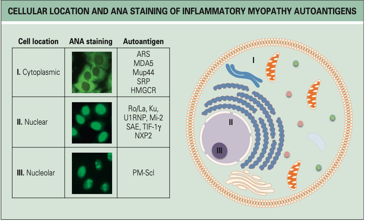 Abhilasha21822's tweet image. ANA staining pattern = poor man’s myositis panel.
Clinical correlation is 🔑
🧐 Suspect myositis but can’t afford a costly antibody profile?🤷♀️🤷♀️
👉 Smart approach = Clinical clues + CPK/LDH + ANA pattern
🔬 ANA can guide you towards the likely autoantibody!
