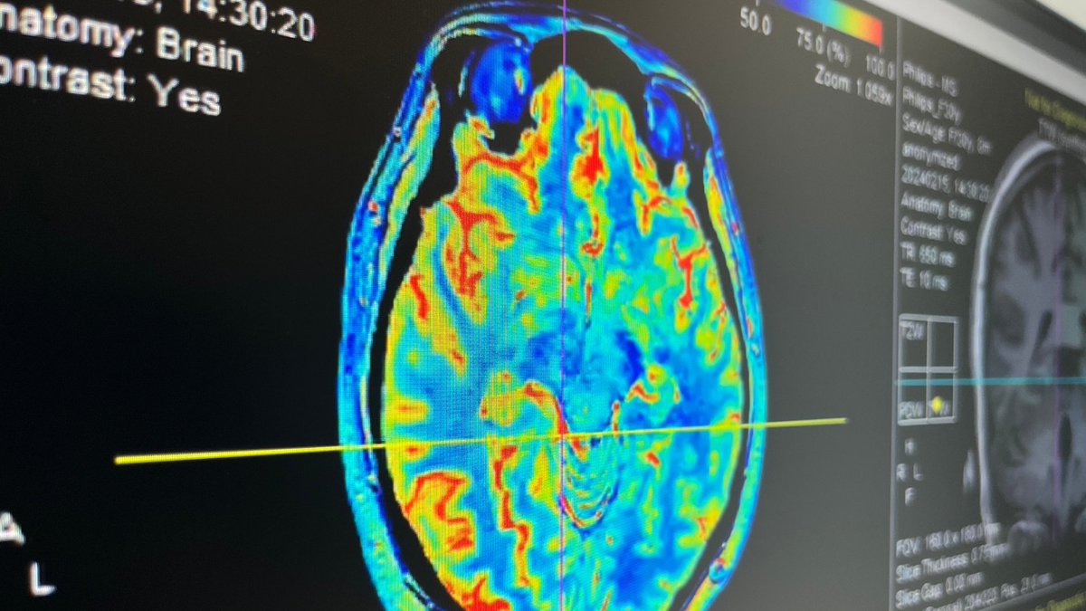 Synthetic_MR's tweet photo. What a great start to #ESNR2025! 💫
Missed us today? Visit Booth 13 tomorrow to learn how qMRI and AI are helping clinicians streamline neuroimaging workflows and make more confident decisions.
#ESNR2025 #AIinHealthcare #QuantitativeMRI #SyMRI #Combinostics #SyntheticMR https://t.co/mKN6MozOBZ