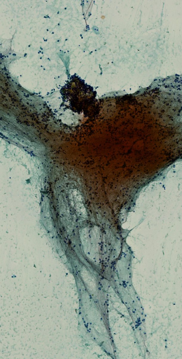 DrCycloPath's tweet photo. 25-year-old, abdominal CT reveals a well-circumscribed, partially cystic and solid mass in the tail of the pancreas. An EUS-FNA is performed. What is your impression?
A) Benign
B) Malignant
C) Gimme a cell block
#CytoPath #PathTwitter #Pathology #PancreasPath https://t.co/D5S02WwQdG